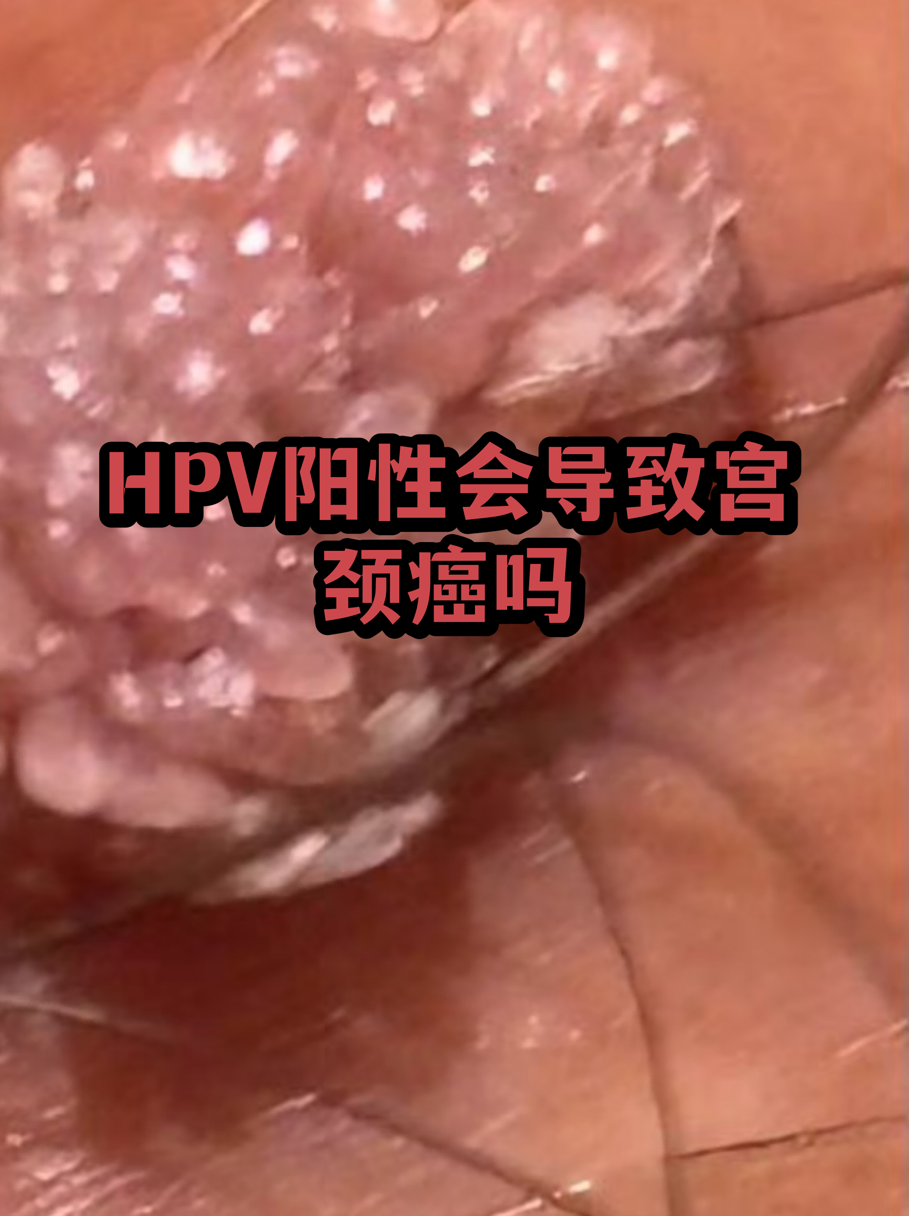 “保定:感染者确实不少	” 保定3人感染病毒？-第2张图片
