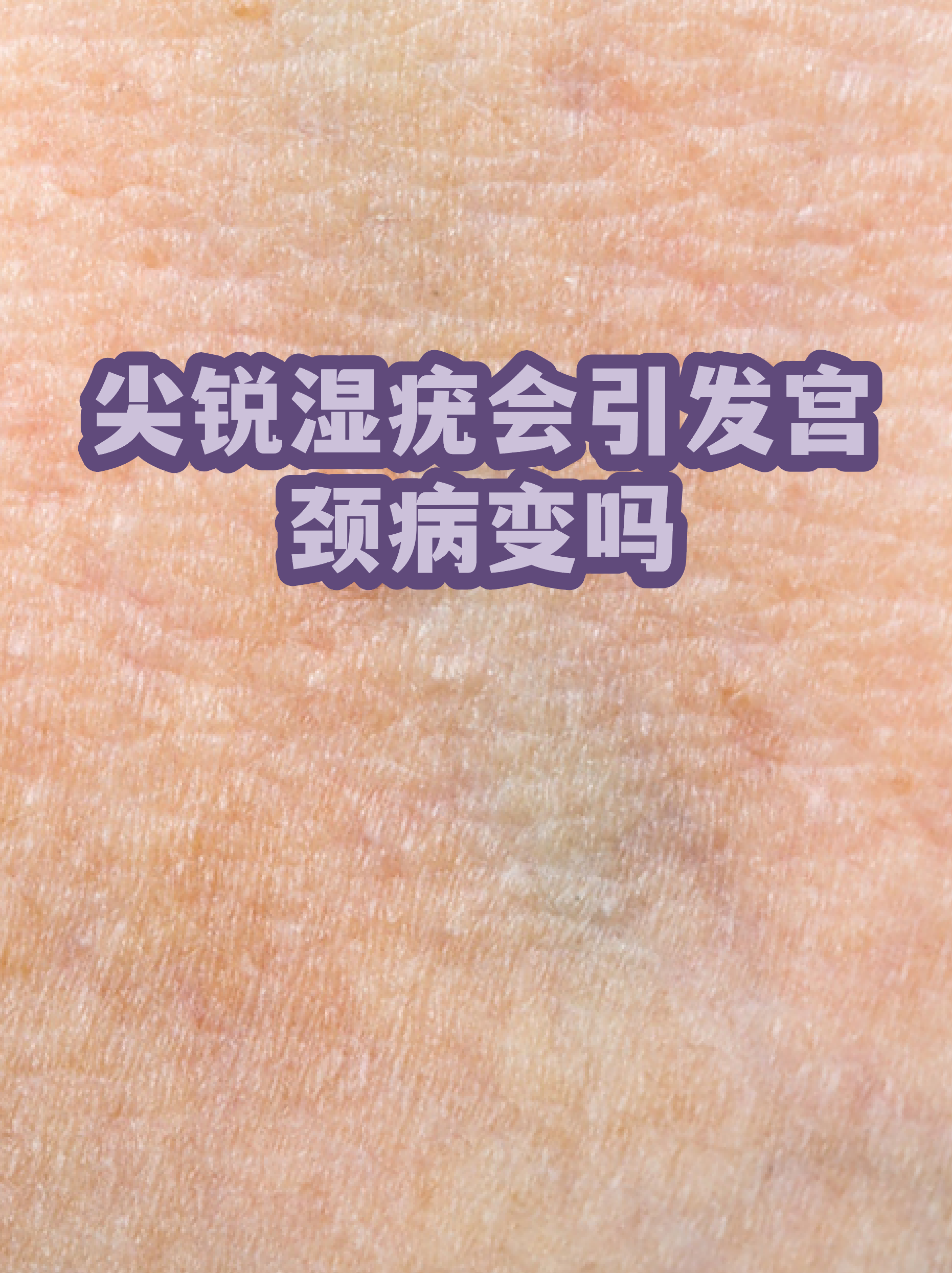 “保定:感染者确实不少” 保定3人感染病毒？
