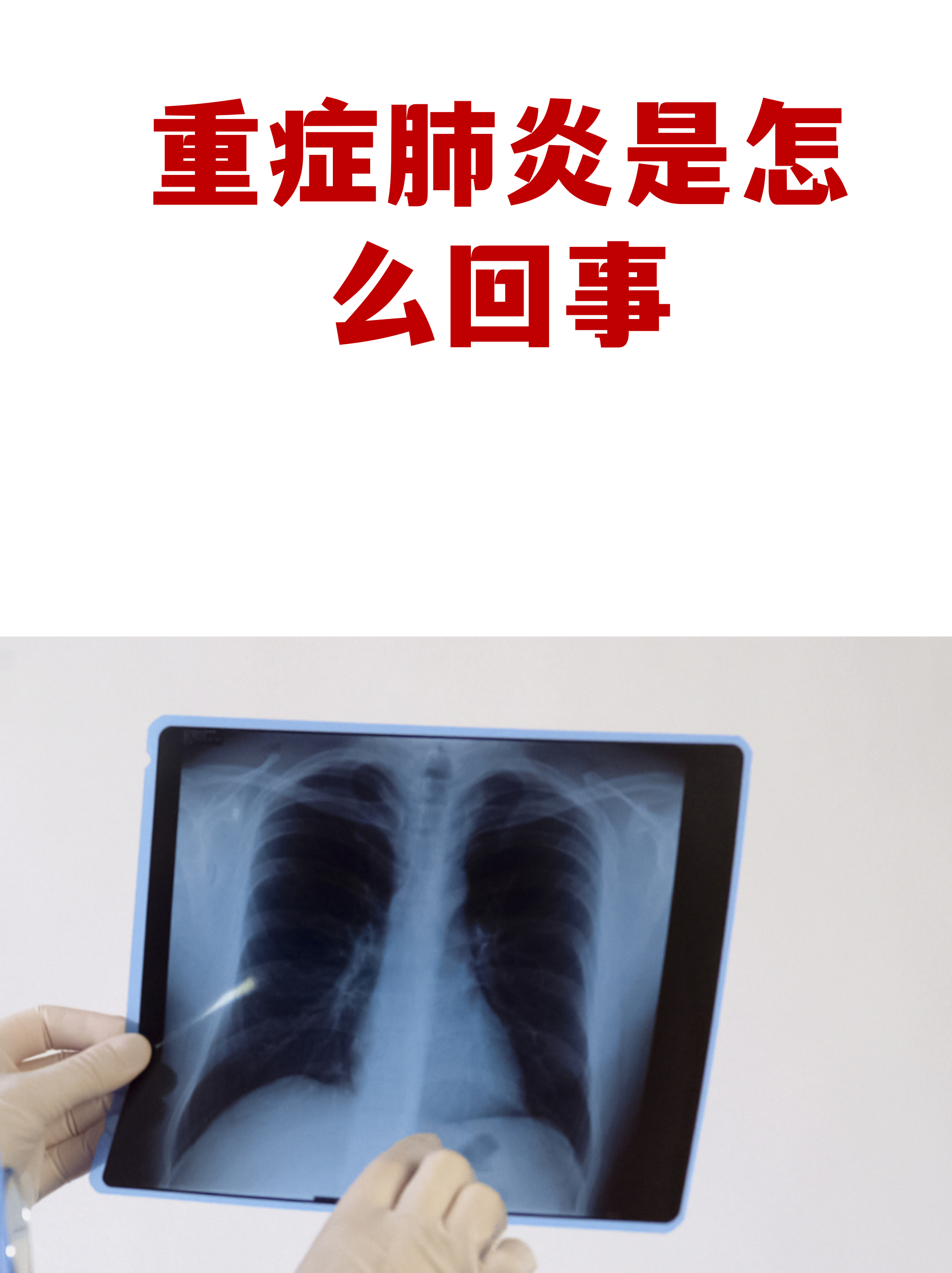 北京现在多少例肺炎〃北京现有多少例新型肺炎-第1张图片